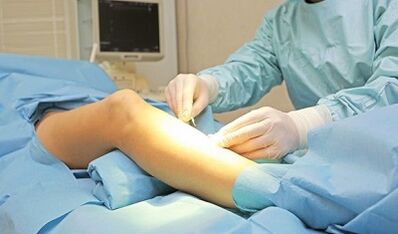 Méthodes de fonctionnement pour traiter les varices chez les femmes