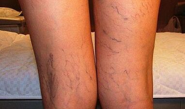 Symptômes de varices chez les femmes