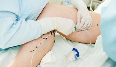 Méthodes de traitement des varices dans les jambes chez les femmes