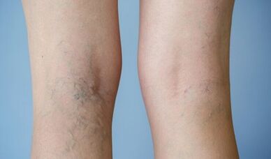 Signes de varices dans les jambes chez les femmes