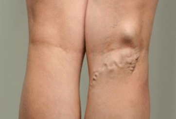 Diagnostic des varices chez la femme enceinte.