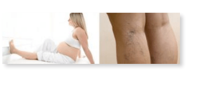 Recommandations pour les varices chez la femme enceinte.