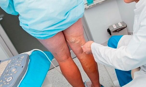 Diagnostic des varices des jambes.