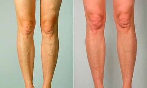 Avant et après le traitement des varices.