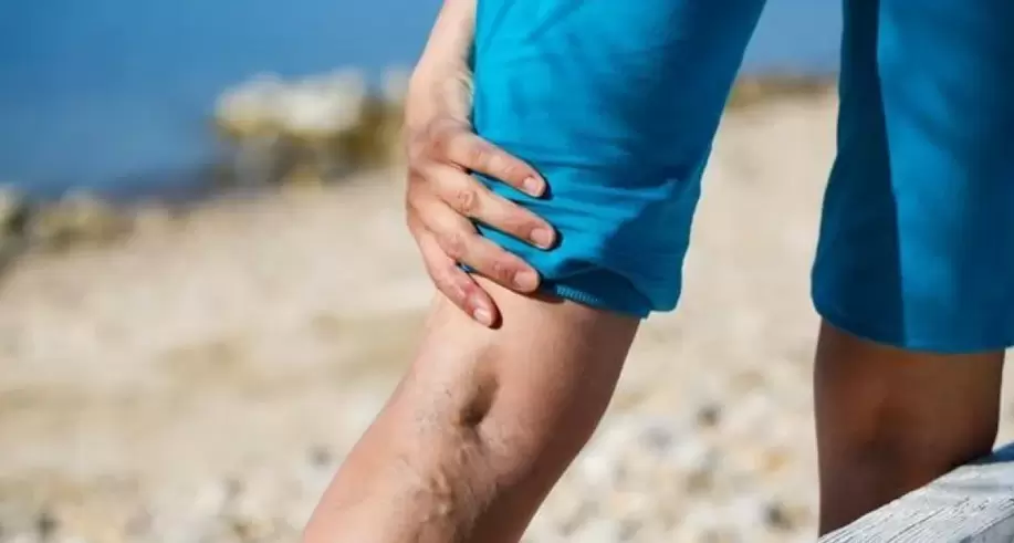 varices dans les jambes