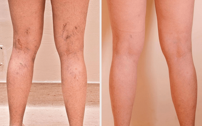 jambes avant et après traitement des varices