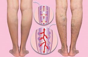 varices des membres inférieurs
