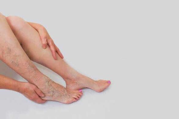 Des veines dilatées et bombées sont le signe de varices dans les membres inférieurs.