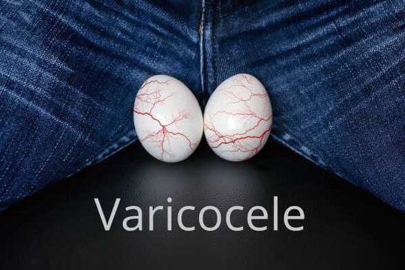 Dilatation varicocèle des veines du cordon spermatique.