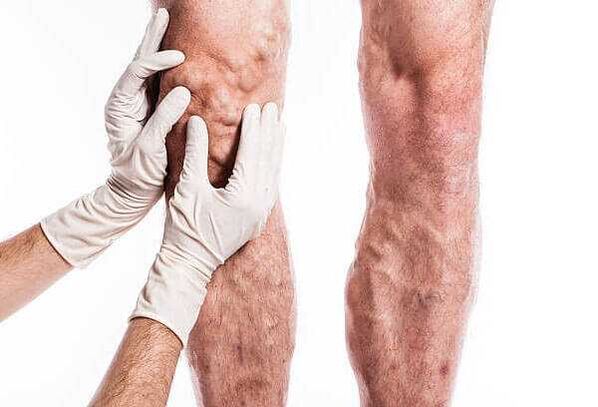 Palpation des varices dans les jambes.